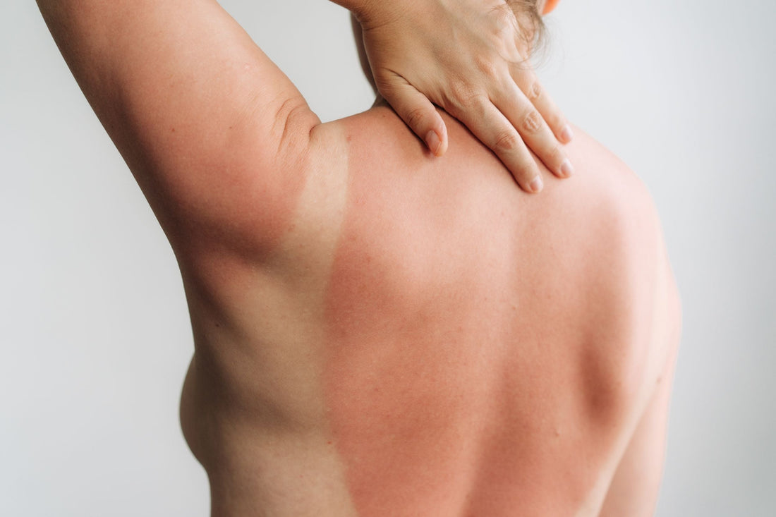 Swimmer with sensitive skin showing how regular clothes can be cause of itchy skin after swimming and why gentle post‑swim outfits matter